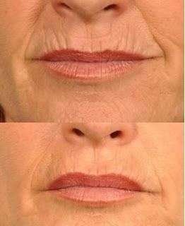 Anti aging, rejuvenecimiento Anti aging, Rejuvenation, rejuvenecimiento