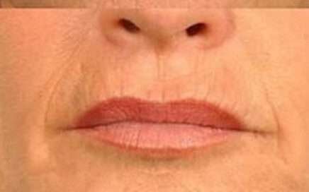 Rejuvenation of the Contour of Mouth and Lip 2 Rejuvenation, Anti aging, rejuvenecimiento