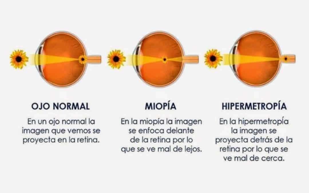 Refractive defects Myopia, hyperopia, and astigmatism Refractive defects Myopia, hyperopia, and astigmatism - miopía